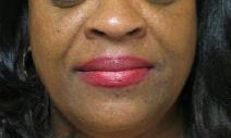 Hyaluronic Acid Before